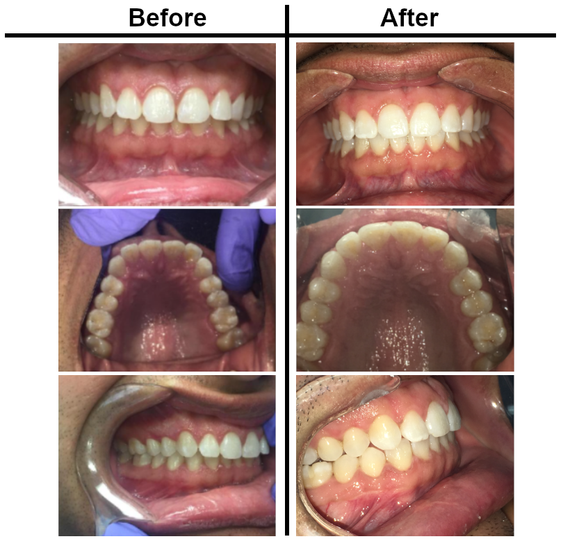 Invisalign Before/After | Bakersfield CA Dentist